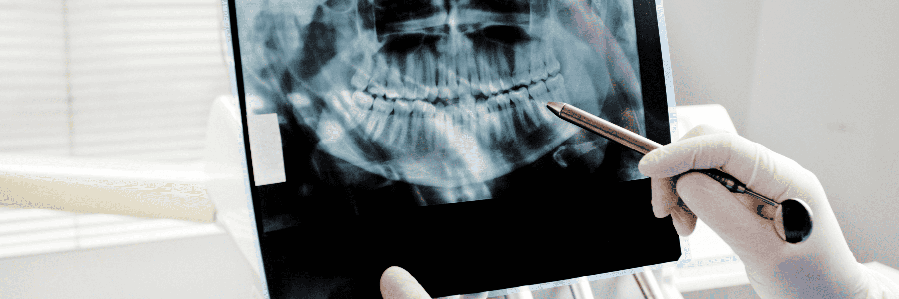 Tooth Extraction | Dentist