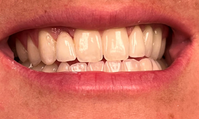 After treatment - Dental Crowns 