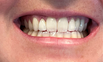 After treatment - Dental Crowns 