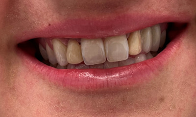 Before treatment - Dental Crowns 